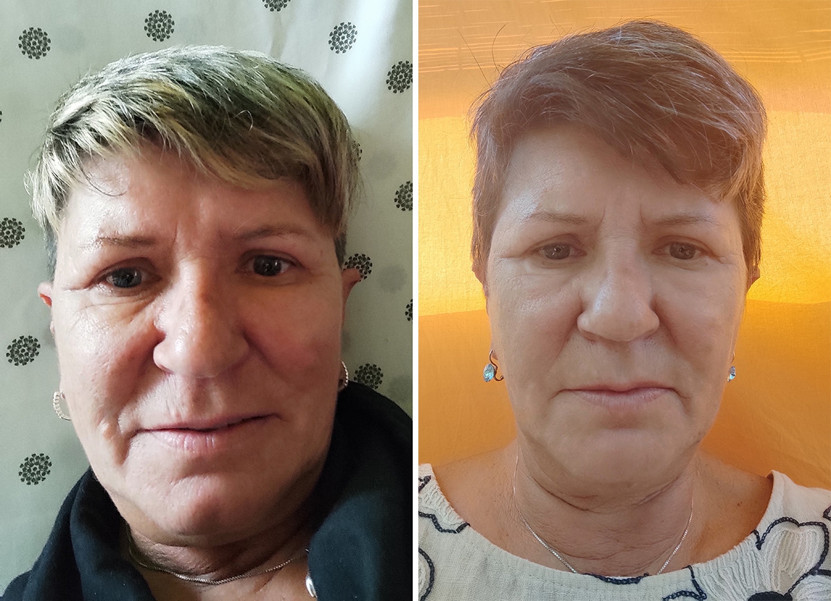 before-after